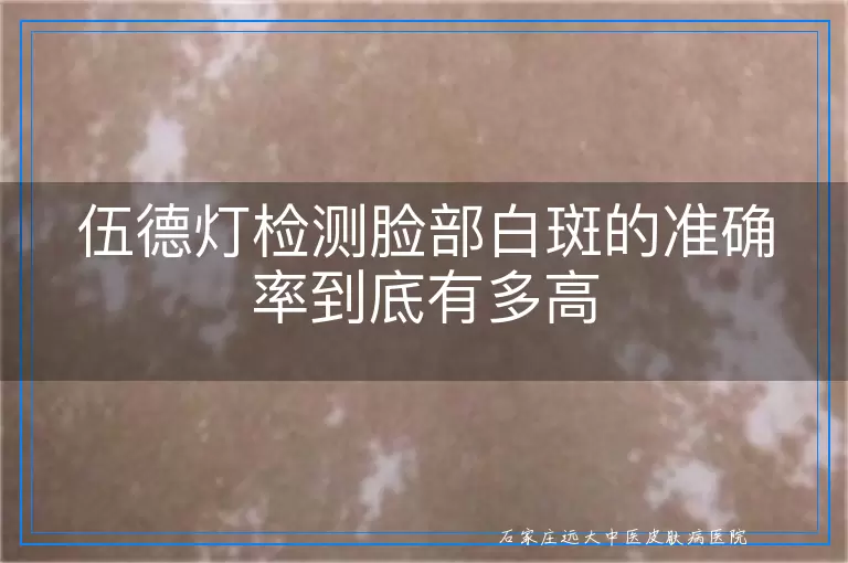 伍德灯检测脸部白斑的准确率到底有多高