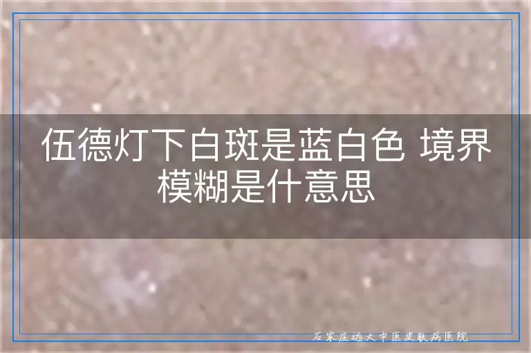 伍德灯下白斑是蓝白色 境界模糊是什意思