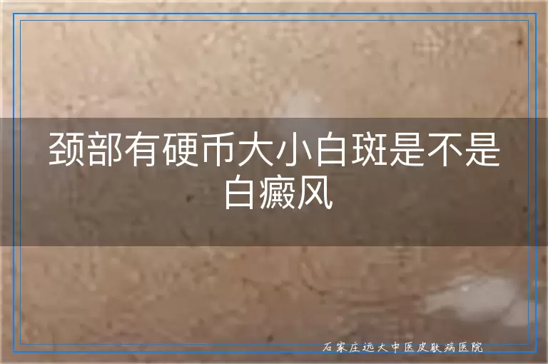 颈部有硬币大小白斑是不是白癜风