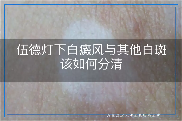 伍德灯下白癜风与其他白斑该如何分清