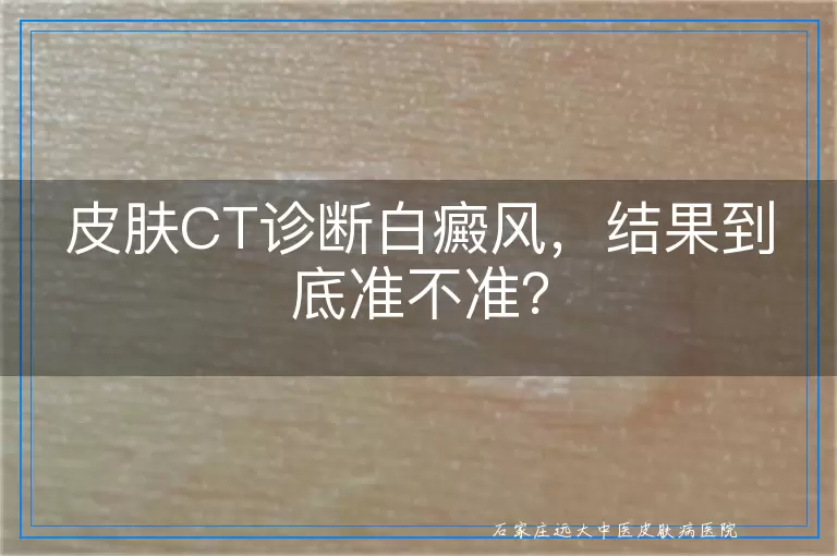 皮肤CT诊断白癜风,结果到底准不准?