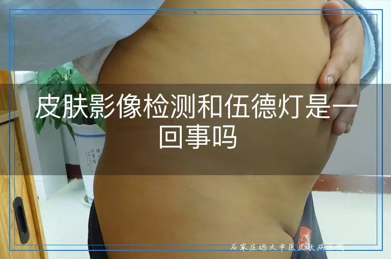 皮肤影像检测和伍德灯是一回事吗