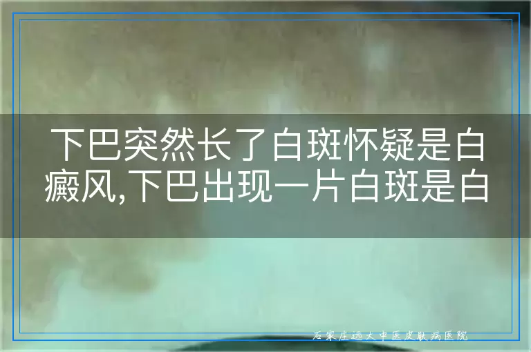 下巴突然长了白斑怀疑是白癜风,下巴出现一片白斑是白癜风吗,下巴白斑咋判断是不是白癜风