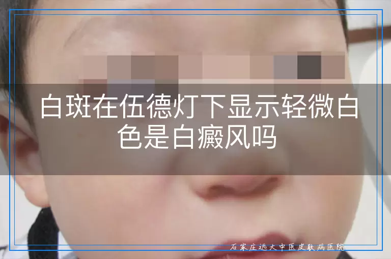 白斑在伍德灯下显示轻微白色是白癜风吗
