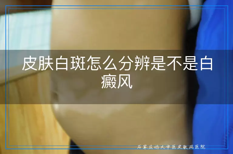 皮肤白斑怎么分辨是不是白癜风