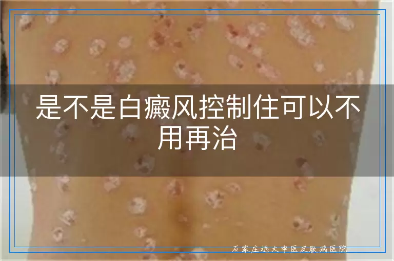 是不是白癜风控制住可以不用再治