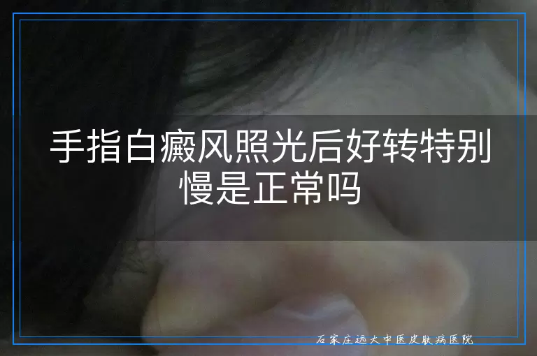 手指白癜风照光后好转特别慢是正常吗