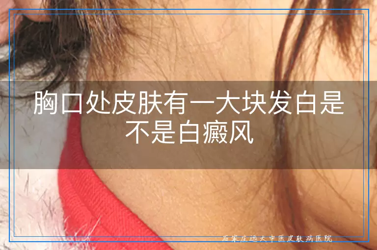 胸口处皮肤有一大块发白是不是白癜风