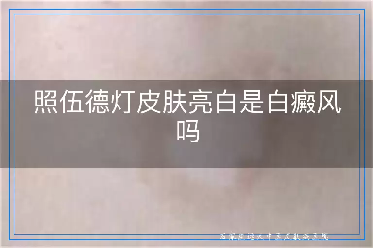 照伍德灯皮肤亮白是白癜风吗