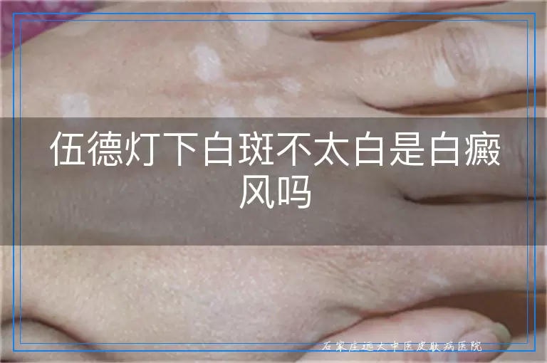 伍德灯下白斑不太白是白癜风吗