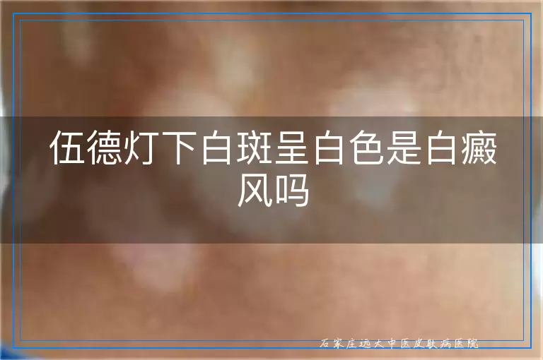 伍德灯下白斑呈白色是白癜风吗