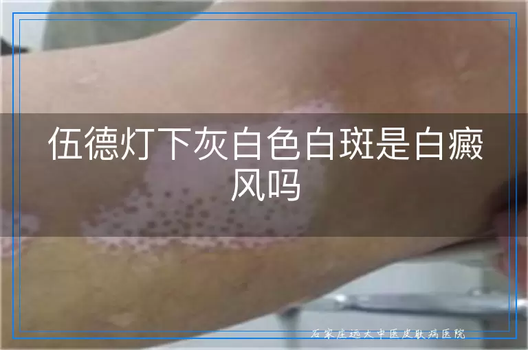 伍德灯下灰白色白斑是白癜风吗