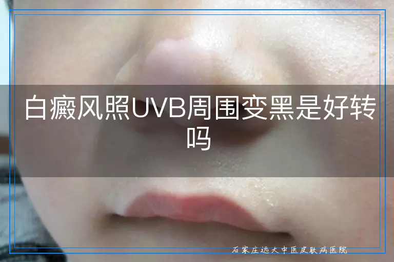 白癜风照UVB周围变黑是好转吗