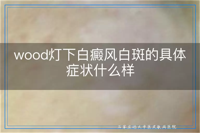 wood灯下白癜风白斑的具体症状什么样