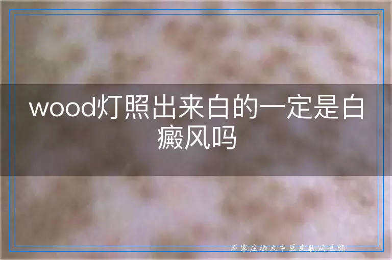 wood灯照出来白的一定是白癜风吗