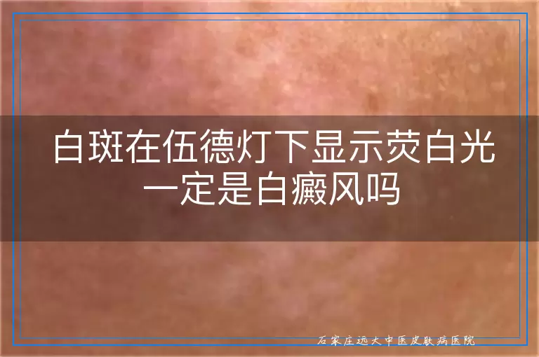 白斑在伍德灯下显示荧白光一定是白癜风吗