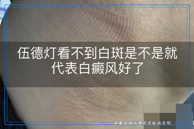 伍德灯看不到白斑是不是就代表白癜风好了