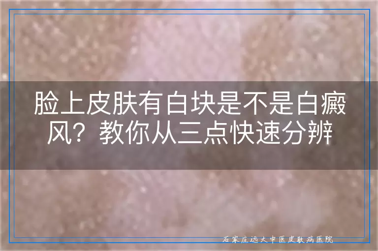 脸上皮肤有白块是不是白癜风?教你从三点快速分辨
