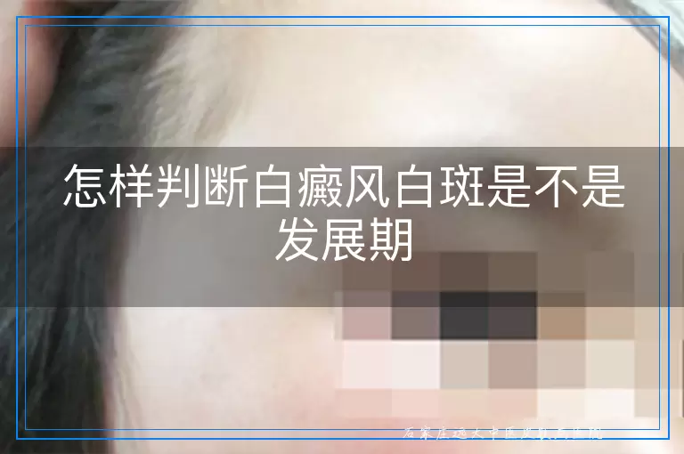 怎样判断白癜风白斑是不是发展期