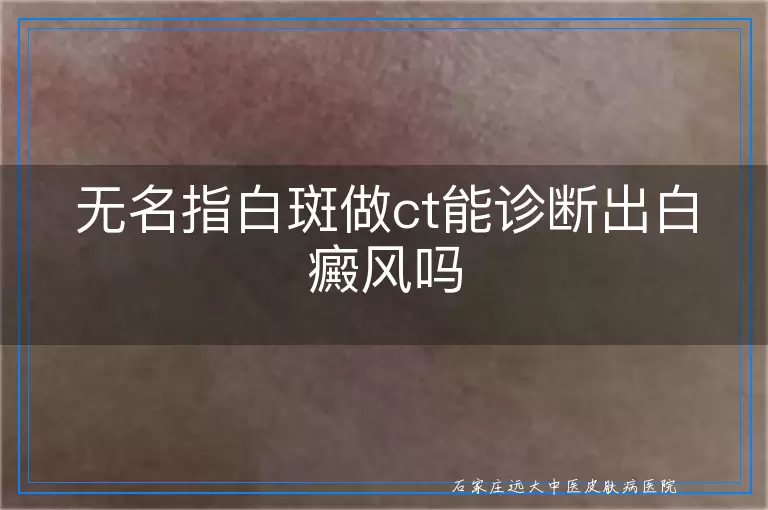 无名指白斑做ct能诊断出白癜风吗