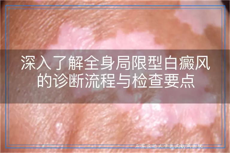 深入了解全身局限型白癜风的诊断流程与检查要点