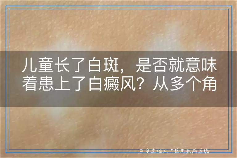 儿童长了白斑，是否就意味着患上了白癜风？从多个角度深入剖析