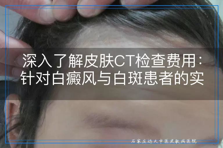 深入了解皮肤CT检查费用：针对白癜风与白斑患者的实用指南