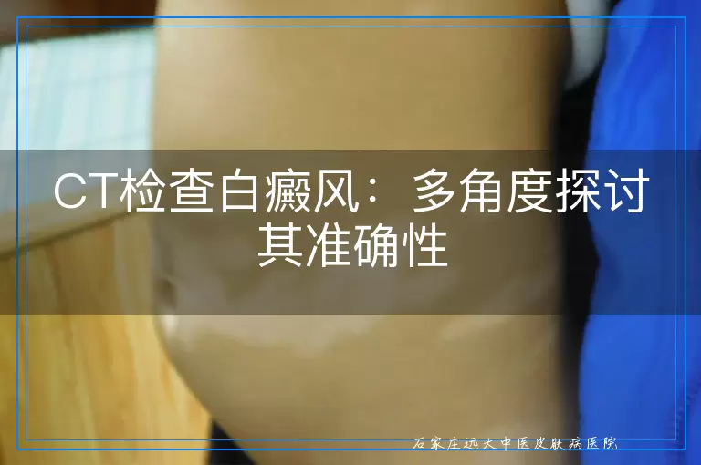 CT检查白癜风：多角度探讨其准确性