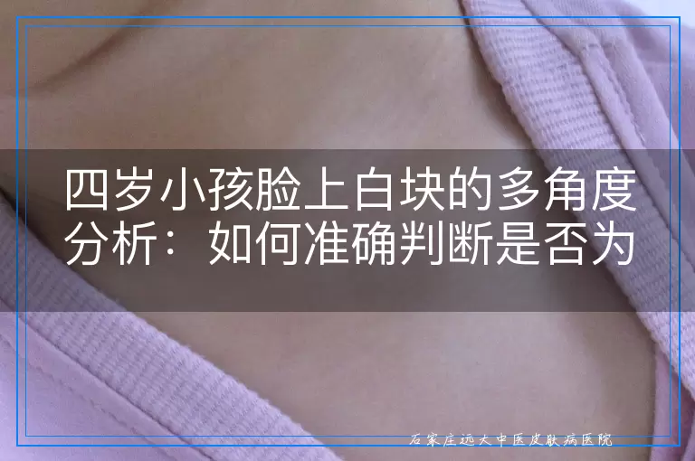四岁小孩脸上白块的多角度分析：如何准确判断是否为白癜风