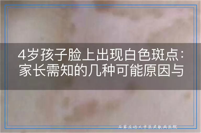 4岁孩子脸上出现白色斑点：家长需知的几种可能原因与应对建议
