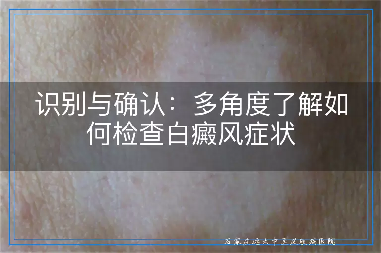识别与确认：多角度了解如何检查白癜风症状