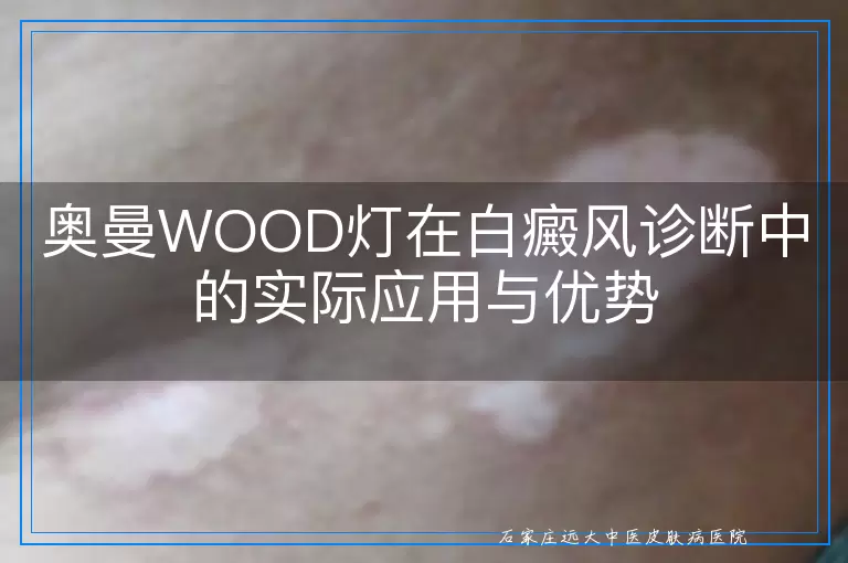 奥曼WOOD灯在白癜风诊断中的实际应用与优势