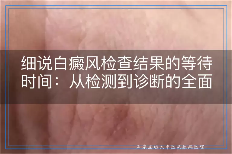 细说白癜风检查结果的等待时间：从检测到诊断的全面流程解析
