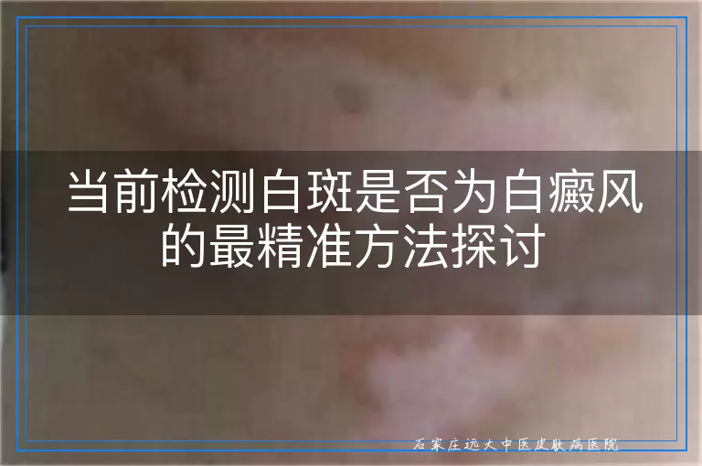 当前检测白斑是否为白癜风的最精准方法探讨
