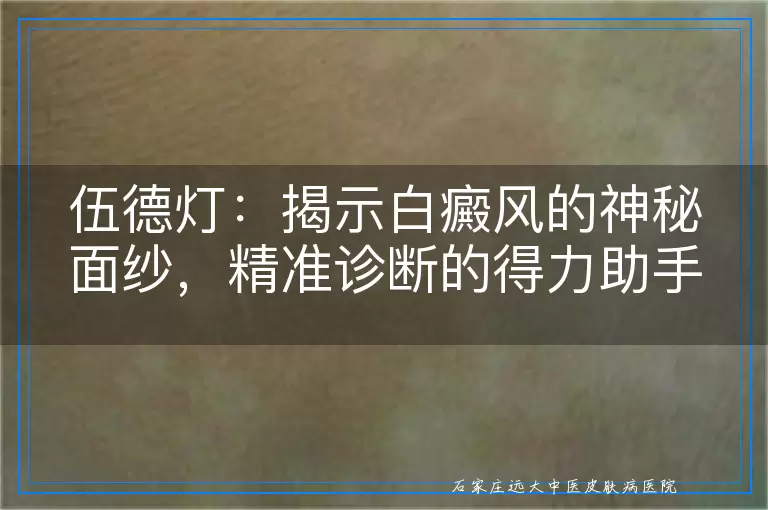 伍德灯：揭示白癜风的神秘面纱，精准诊断的得力助手