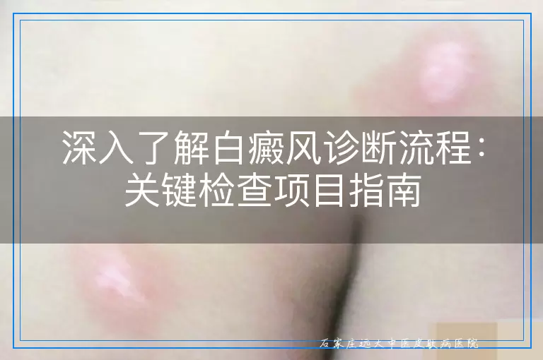 深入了解白癜风诊断流程：关键检查项目指南