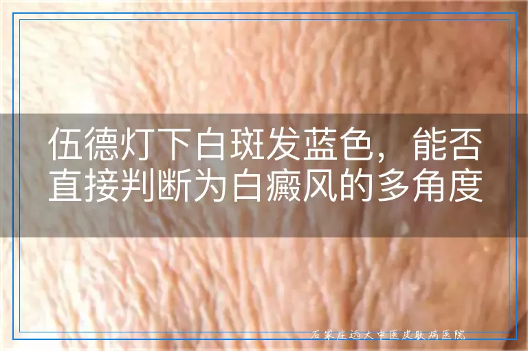 伍德灯下白斑发蓝色，能否直接判断为白癜风的多角度探讨