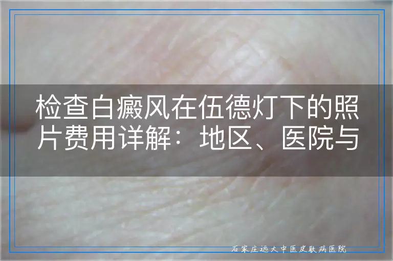 检查白癜风在伍德灯下的照片费用详解：地区、医院与检查范围的差异