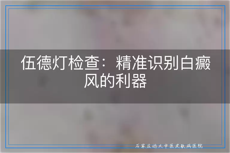 伍德灯检查：精准识别白癜风的利器