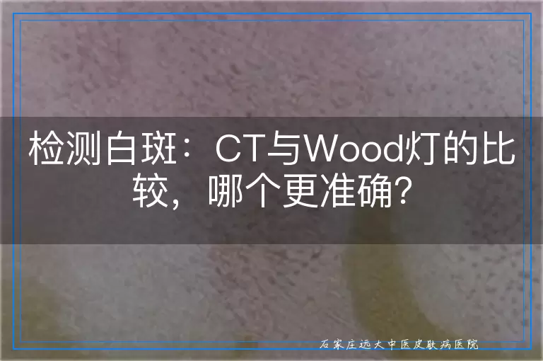 检测白斑：CT与Wood灯的比较，哪个更准确？