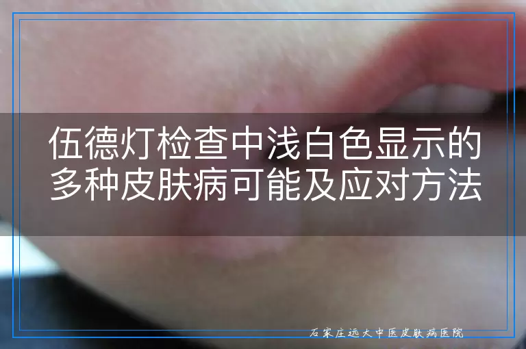 伍德灯检查中浅白色显示的多种皮肤病可能及应对方法