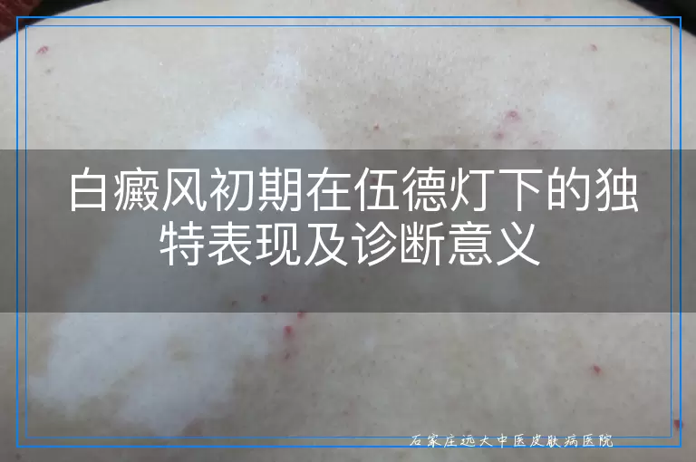 白癜风初期在伍德灯下的独特表现及诊断意义