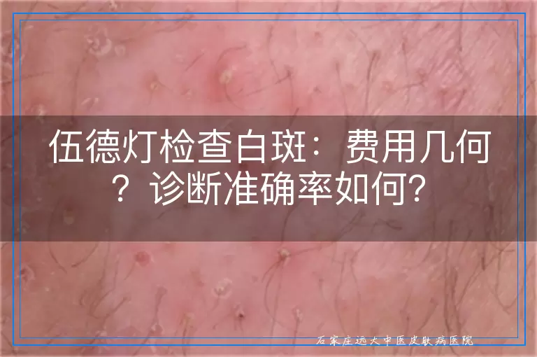 伍德灯检查白斑：费用几何？诊断准确率如何？