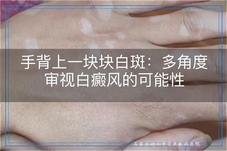 手背上一块块白斑：多角度审视白癜风的可能性