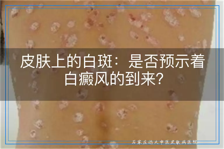 皮肤上的白斑：是否预示着白癜风的到来？