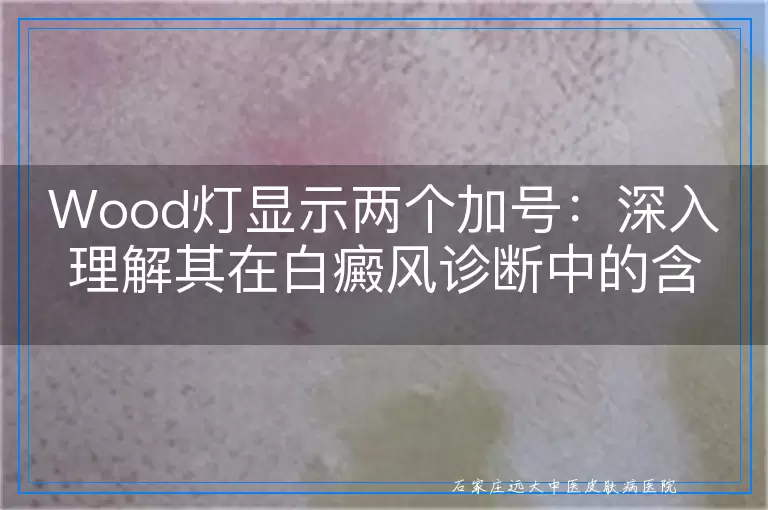 Wood灯显示两个加号：深入理解其在白癜风诊断中的含义与应用