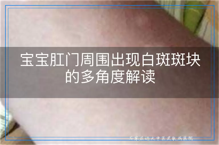 宝宝肛门周围出现白斑斑块的多角度解读