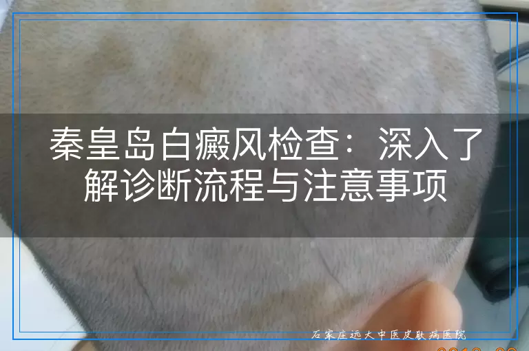 秦皇岛白癜风检查：深入了解诊断流程与注意事项