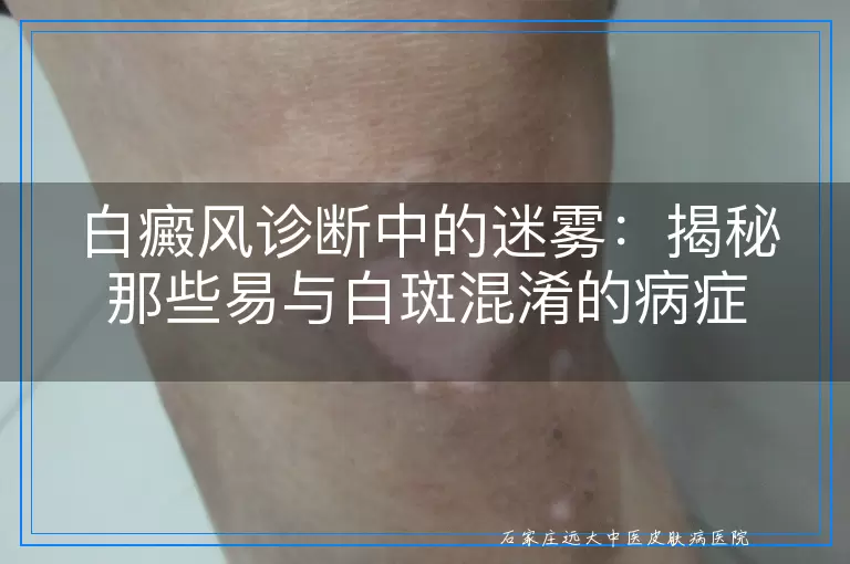 白癜风诊断中的迷雾：揭秘那些易与白斑混淆的病症
