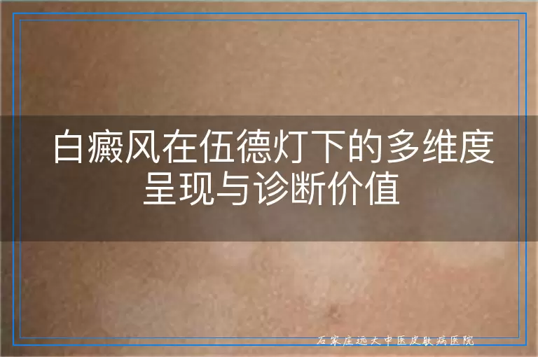 白癜风在伍德灯下的多维度呈现与诊断价值